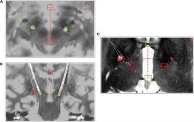 Rescue procedure for isolated dystonia after the secondary failure of globus pallidus internus deep brain stimulation